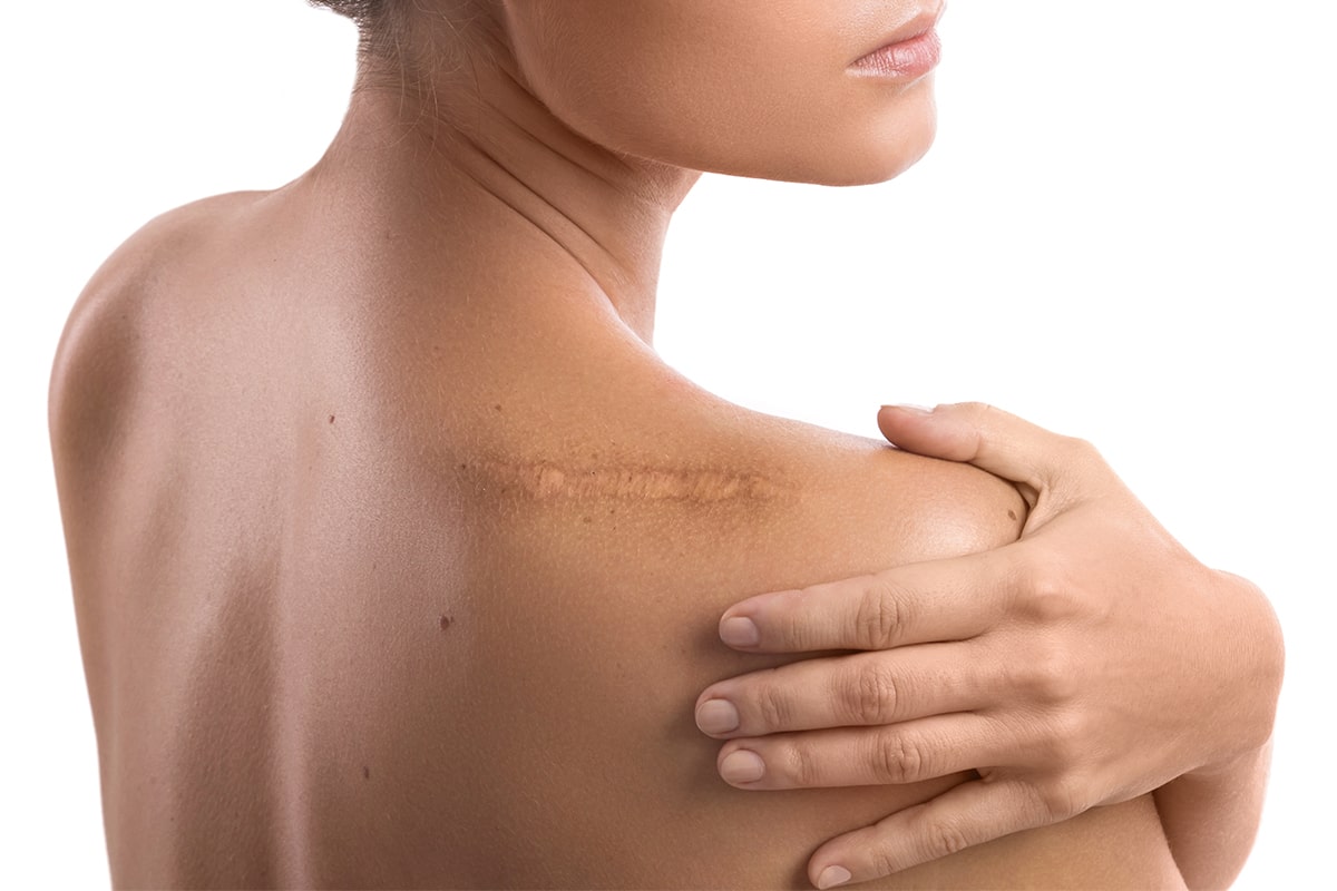 aceite de rosa mosqueta para cicatrices