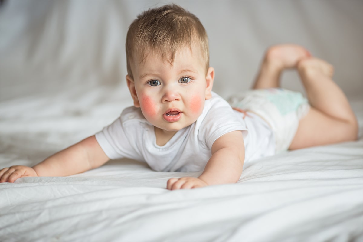 piel atópica bebés