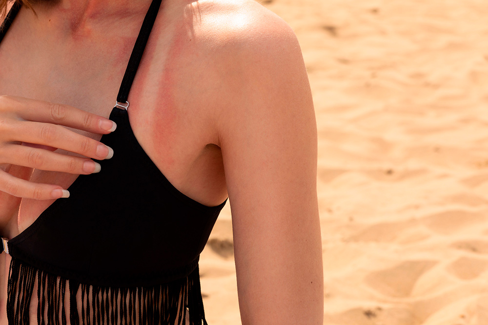 Quemadura por exposición al sol