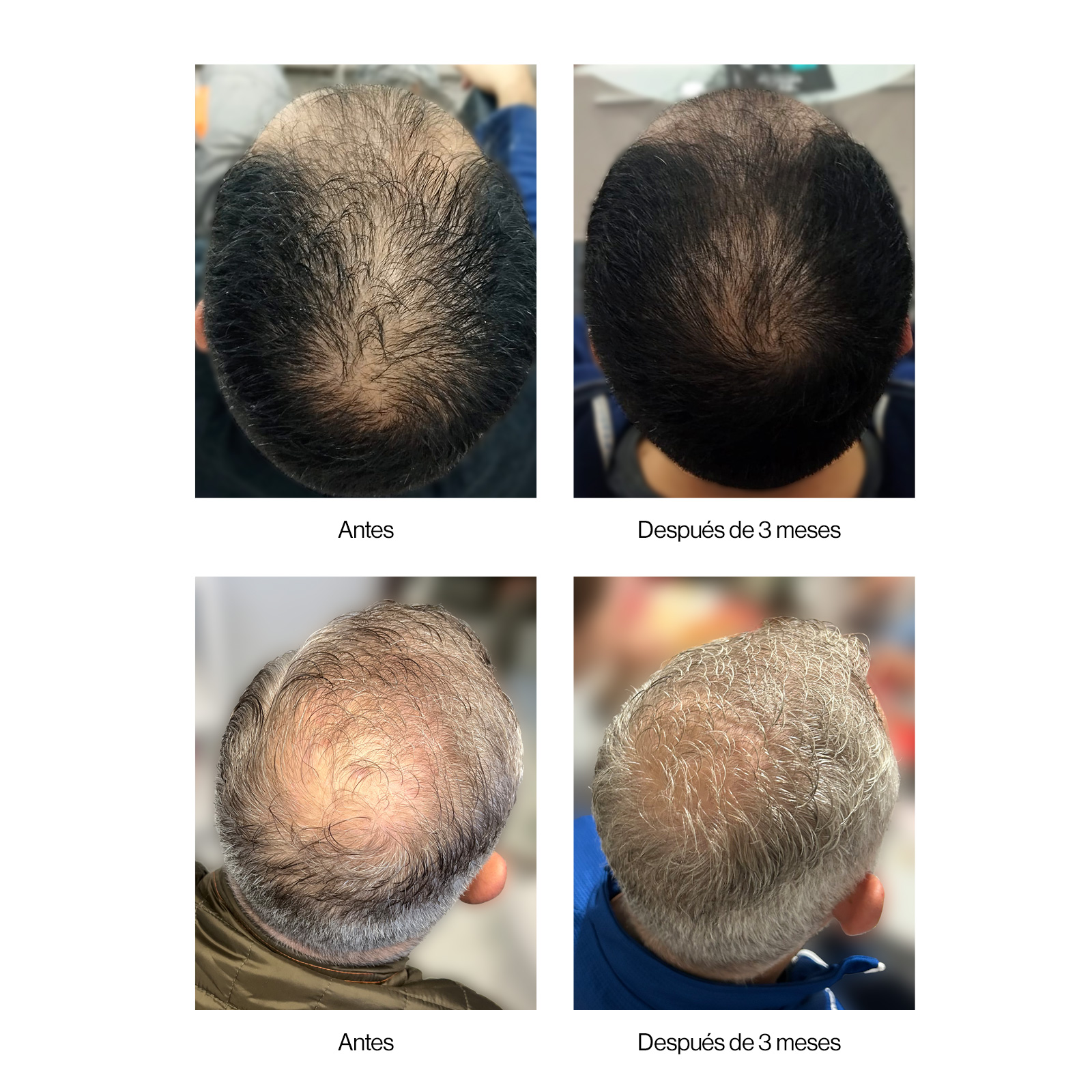 Antes y después del uso del Champú Neoxil Peptide