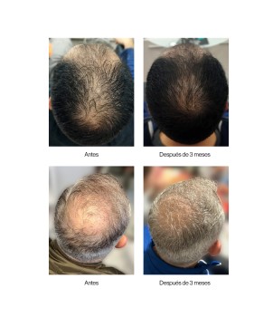 Champú anticaída densificante Neoxil Peptide