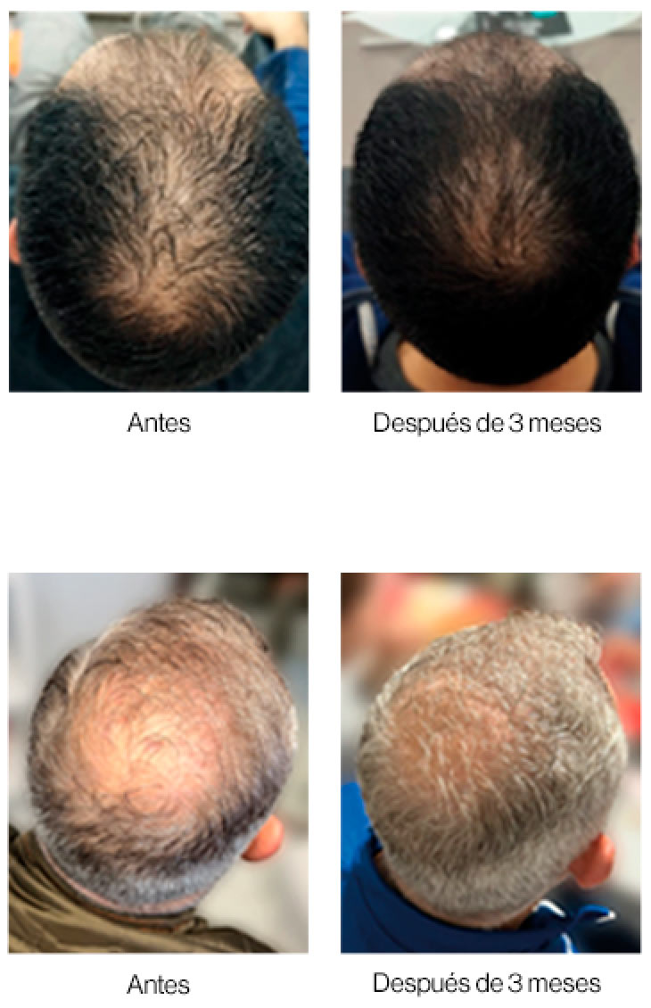 Neoxil Peptide antes y después